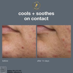 Công dụng của Dermalogica Deep Breakout Liquid Patch