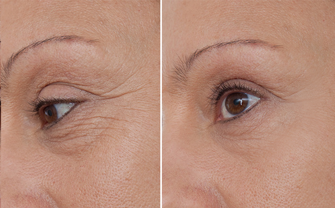 Công dụng của tinh chất giảm nhăn vùng mắt Mesoestetic Collagen 360 Eye Contour