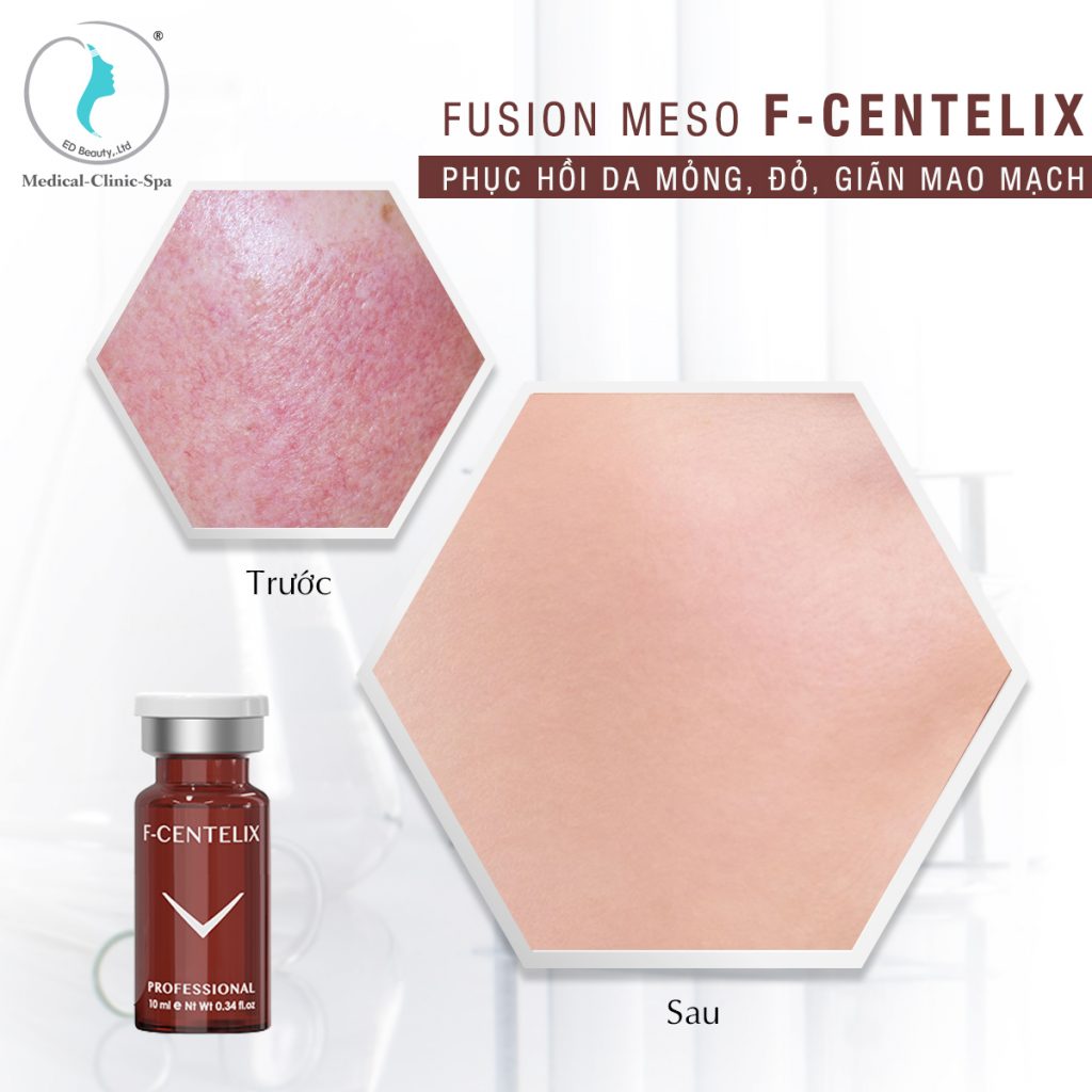 Phác đồ Fusion Meso F-Centelix phục hồi da mỏng, đỏ, giãn mao mạch
