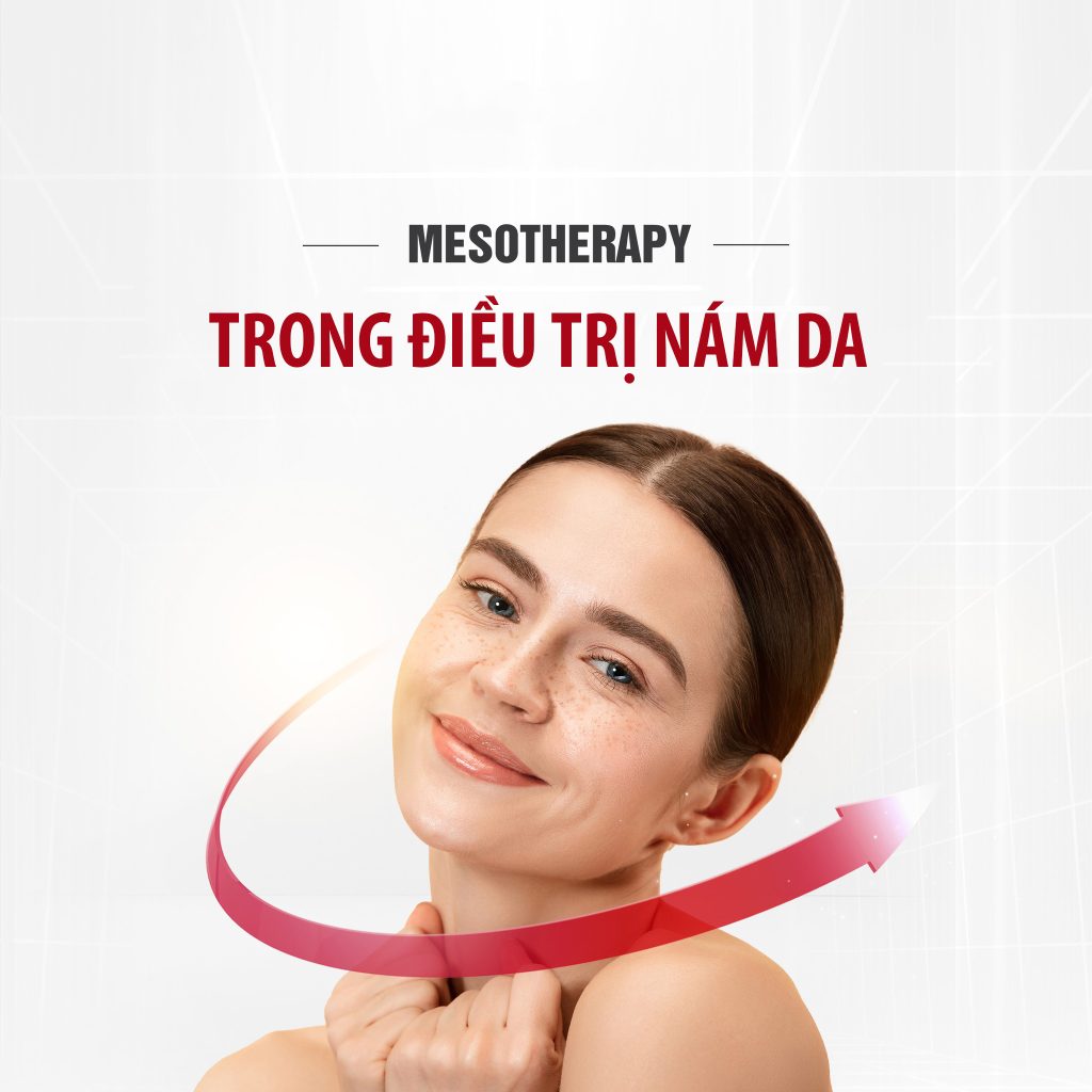 Phương pháp Mesotherapy trong điều trị nám da
