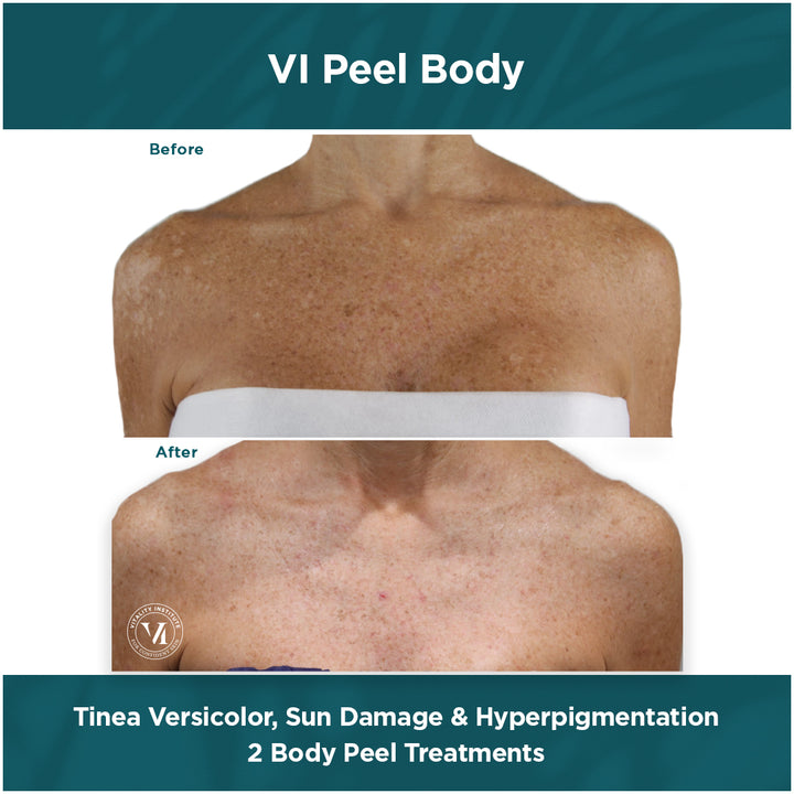 Bộ peel da VI Peel Body dành cho vùng da cơ thể - Ảnh 4