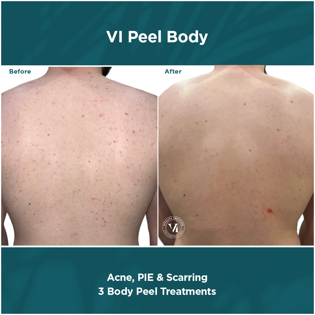 Bộ peel da VI Peel Body dành cho vùng da cơ thể - Ảnh 6