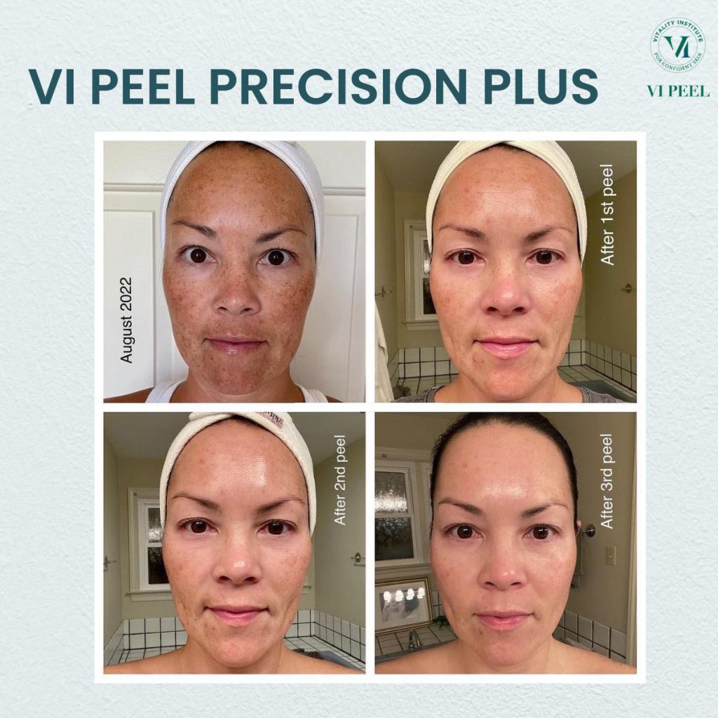 Công dụng của bộ peel da nám, tăng sắc tố VI Peel With Precision Plus