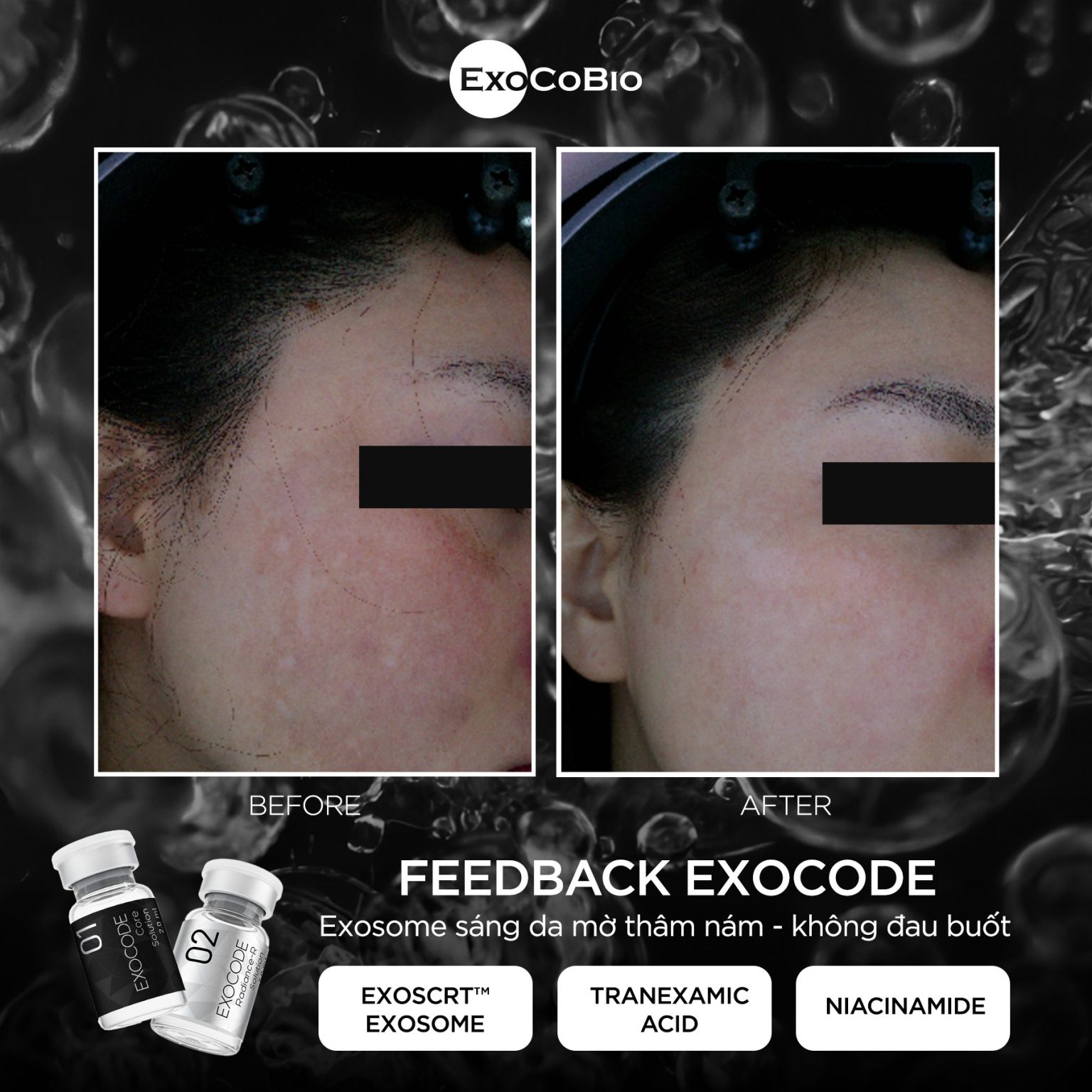 Exocode Radiance - R cấy làm sáng da và điều trị nám