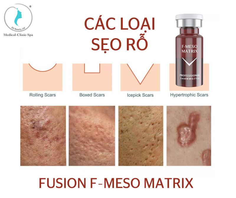 3. F- Meso Matrix sản phẩm điều trị sẹo rỗ