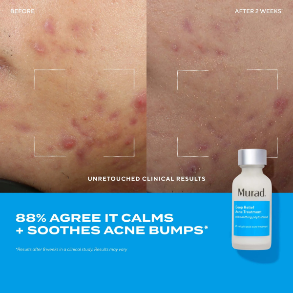 Sữa chấm mụn chuyên sâu Murad Deep Relief Acne Treatment - Hình ảnh 4