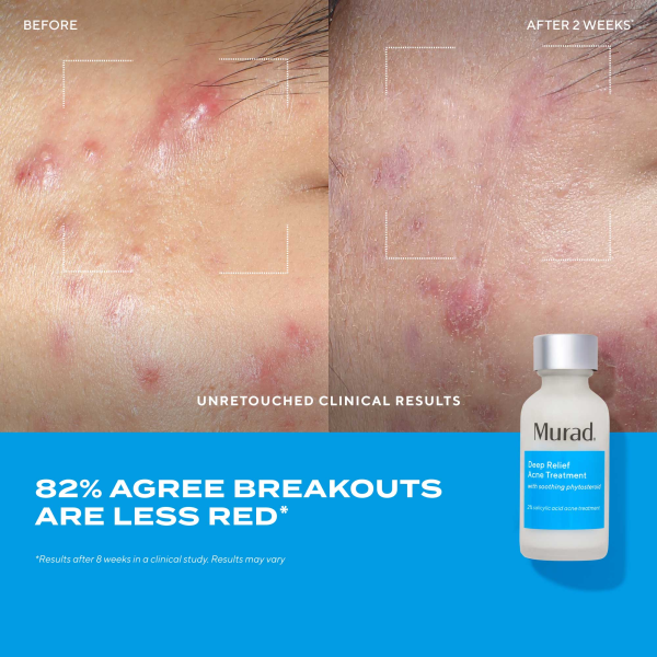 Sữa chấm mụn chuyên sâu Murad Deep Relief Acne Treatment - Hình ảnh 5