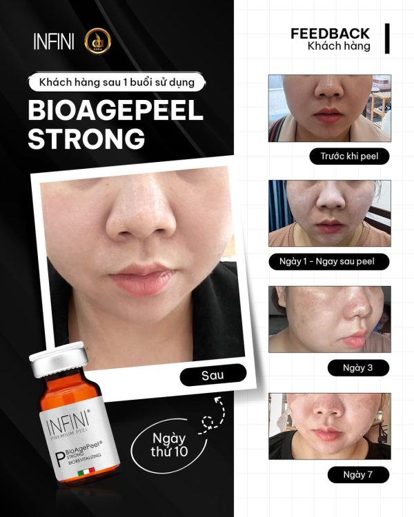Dung dịch Peel da nám, mụn và cải thiện sẹo rỗ Infini BioAgePeel Strong - Hình ảnh 4