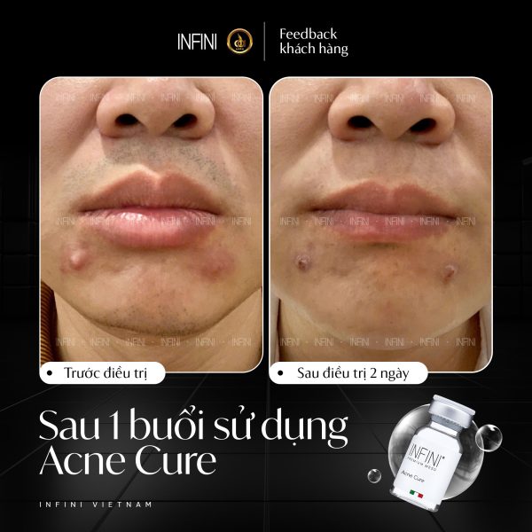 Tinh chất kháng khuẩn, chống viêm, trị mụn Infini Premium Meso AcneCure - Hình ảnh 3