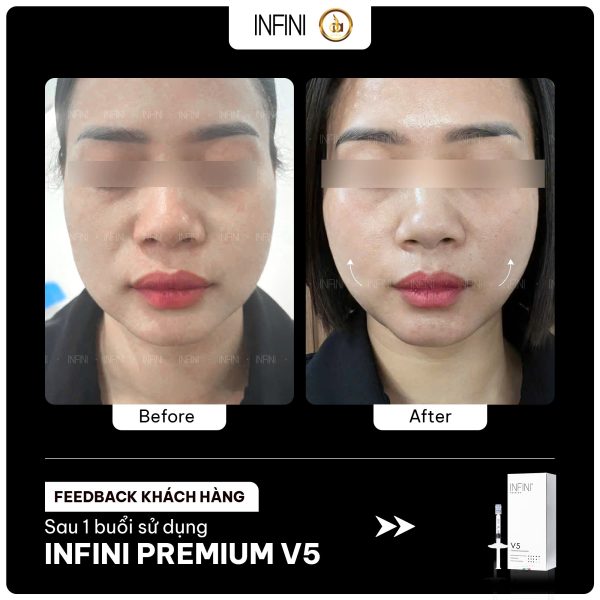 Tinh chất BAP cải thiện nếp nhăn nông, căng mướt da Infini V5 Contour Stimulator - Hình ảnh 5
