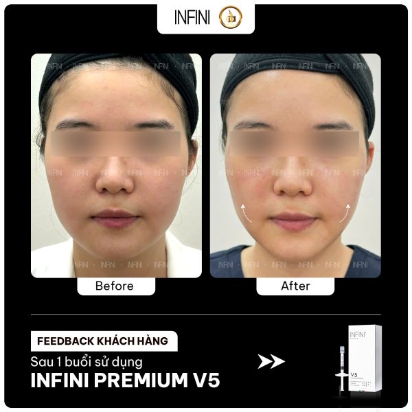 Tinh chất BAP cải thiện nếp nhăn nông, căng mướt da Infini V5 Contour Stimulator - Hình ảnh 4