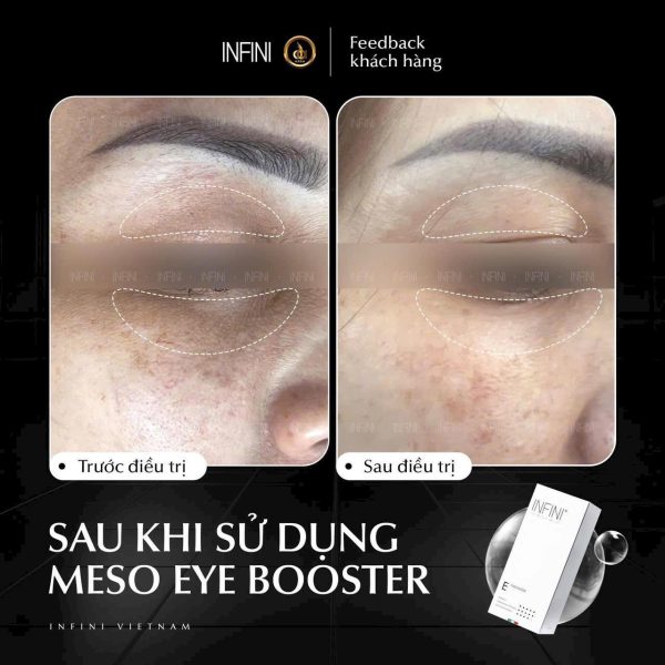 Tinh chất mờ nhăn, trẻ hóa vùng da mắt sáng khỏe Infini Meso E Eyebooster - Hình ảnh 5