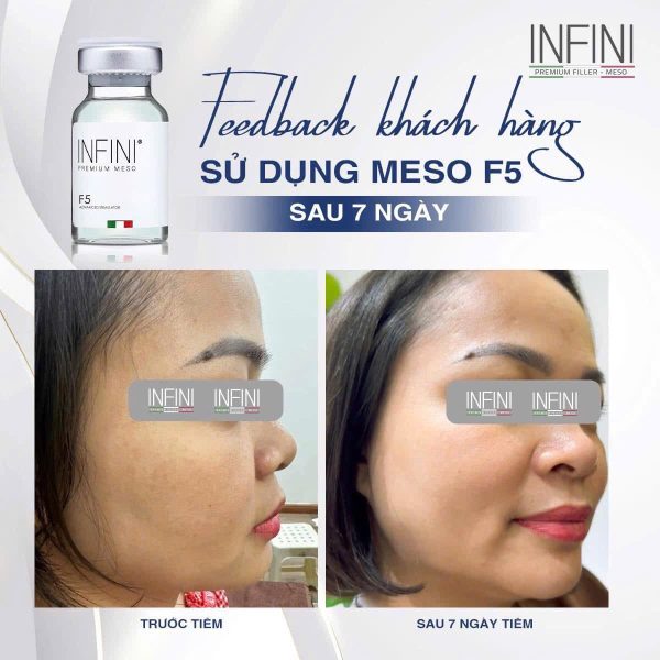 Cocktail giảm nhăn, tái tạo và trẻ hóa làn da sáng mịn Infini Premium Meso F5 - Hình ảnh 5