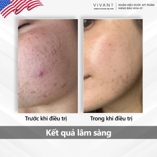 Tinh chất hỗ trợ trị mụn, trẻ hóa da Vivant 15% Mandelic Acid 3-in 1 Serum  - Hình ảnh 4