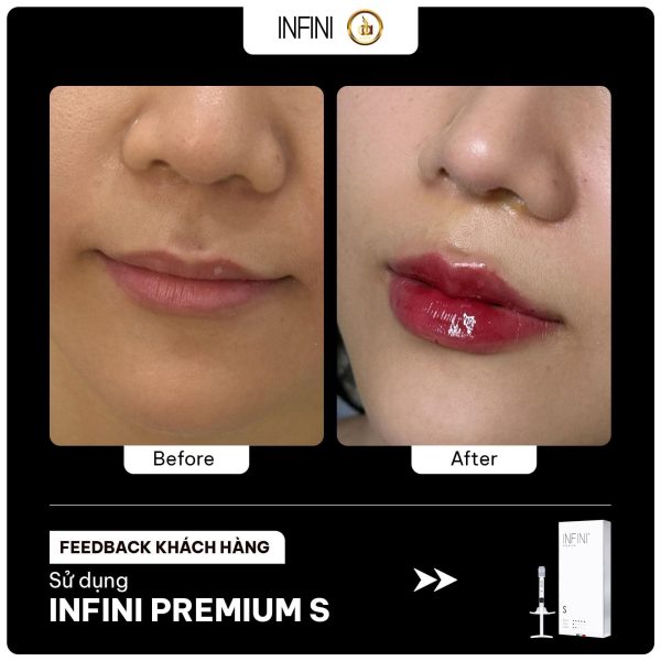 Tinh chất làm đầy nếp nhăn nhẹ, căng mọng da Infini Premium Filler S - Hình ảnh 5