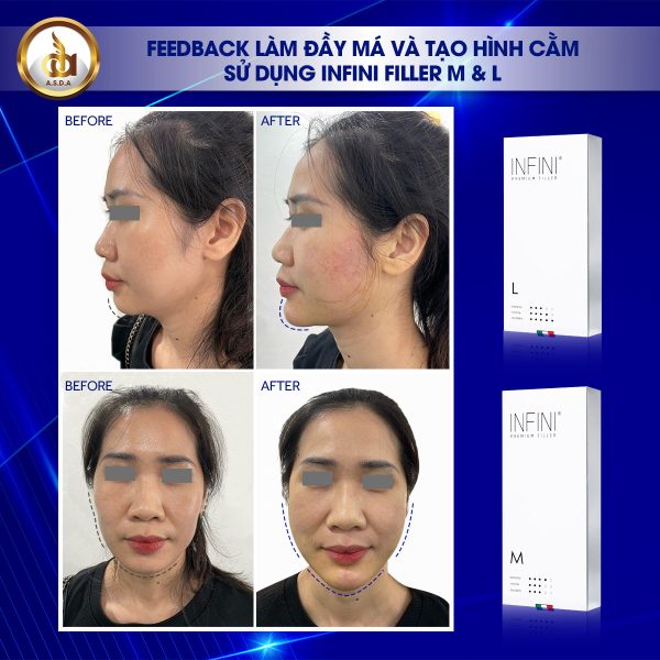 Tinh chất nâng đầy môi, giảm nếp nhăn khóe mũi và da tay Infini Premium Filler M - Hình ảnh 4