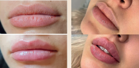 Hiệu quả sau liệu trình Filler môi Infini (Nguồn: Infini)