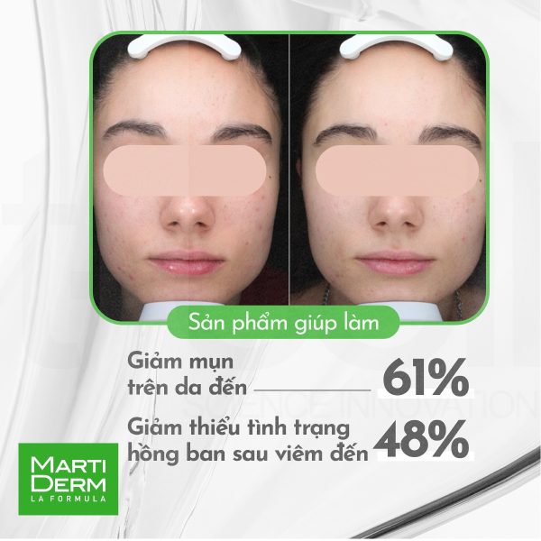 Kem dưỡng cân bằng vi sinh, giảm nhờn mụn viêm MartiDerm Acniover Cicavent - Hình ảnh 6