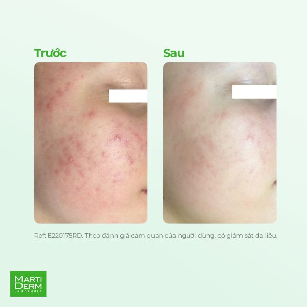 Kem dưỡng cân bằng vi sinh, giảm nhờn mụn viêm MartiDerm Acniover Cicavent - Hình ảnh 7
