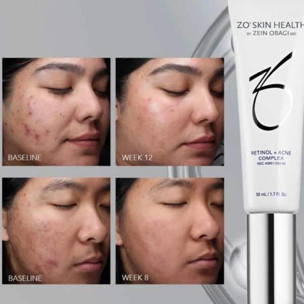 Serum trị mụn, giảm thâm & mờ sẹo ZO® Skin Health Retinol + Acne Complex - Hình ảnh 5