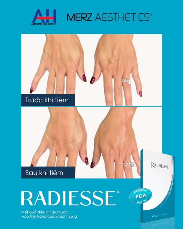Tinh chất filler, kích thích sản sinh collagen tự thân Radiesse - Hình ảnh 3