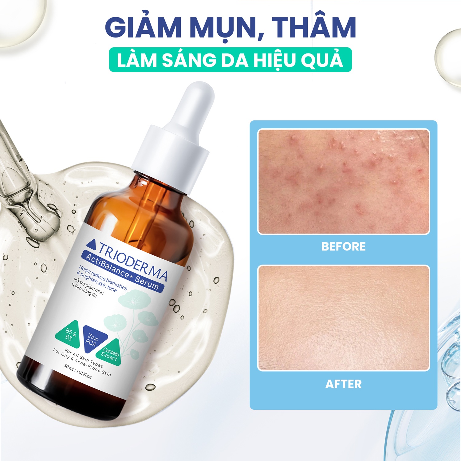 Tinh chất hỗ trợ giảm mụn, mờ thâm Trioderma ActiBalance+ Serum - Hình ảnh 6