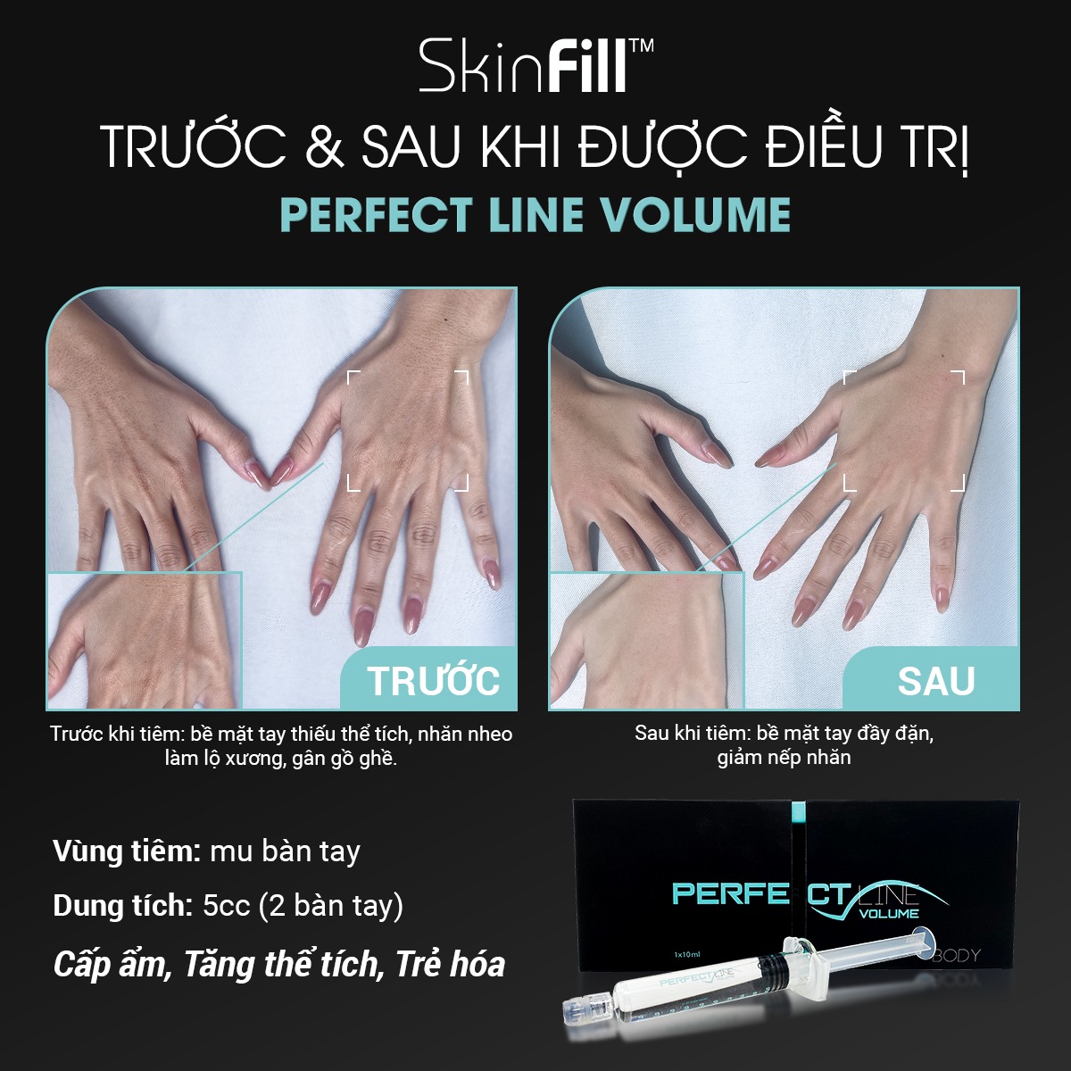 Filler HA làm đầy, trẻ hóa body Skinfill Perfect Line Volume - Hình ảnh 3