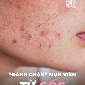 Skincare ngăn ngừa, ức chế mụn sưng viêm