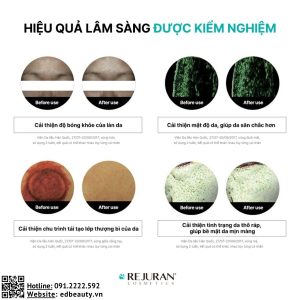 Rejuran Turnover Ampoule kết quả lâm sàn hiệu quả sử dụng