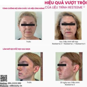 Dung dịch HA Trehalose tái tạo da chuyên sâu RetixC Resteeme X