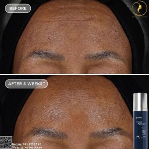 Hiệu quả khi dùng Ageless+ Retinol 1.2%