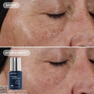 Ageless+ Retinol Pure Liquid Retinol 0.1% phù hợp với ai?