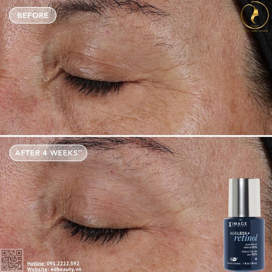 Hiệu quả khi dùng Ageless+ Pure Liquid Retinol 0.1%