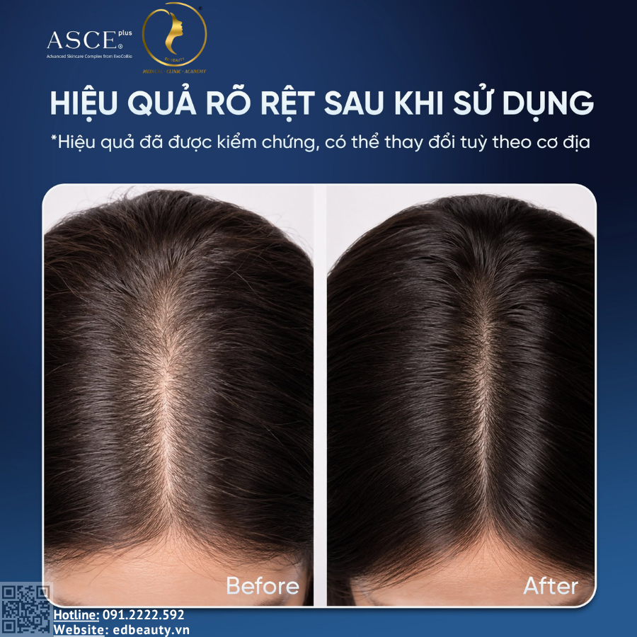 Xịt dưỡng tóc Exomist Platinum HR phù hợp với ai?
