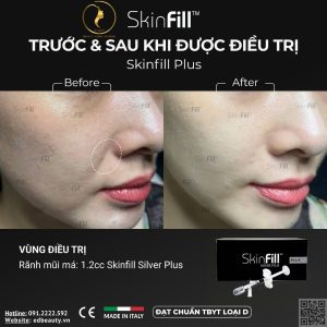 Chỉ định của SkinFill Silver Plus
