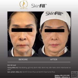 Chỉ định của SkinFill Silver Plus