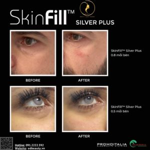 Chỉ định của SkinFill Silver Plus