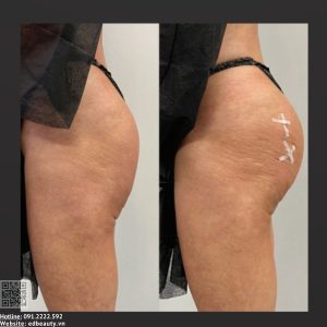 HA làm đầy sẹo lõm, định hình cơ thể SkinFill™ Body