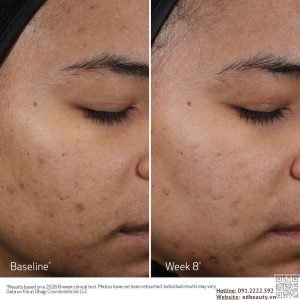 Hiệu quả khi dùng M.D. Resurfacing Multi-Acid Peel Pads