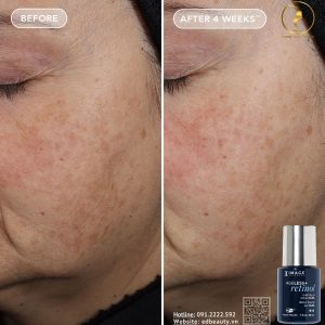 Ageless+ Retinol Pure Liquid 0.3% phù hợp với ai?