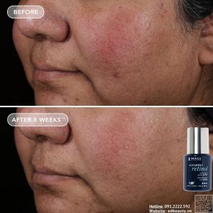 Hiệu quả khi dùng Retinol Pure Retinol 0.75%