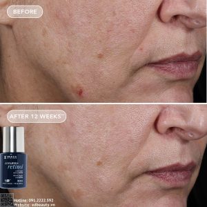 Hiệu quả khi dùng Retinol Pure Retinol 0.75%