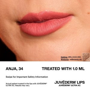 Filler Juvéderm® Ultra XC môi căng đầy