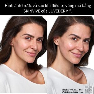 SKINVIVE by JUVÉDERM® phù hợp với ai
